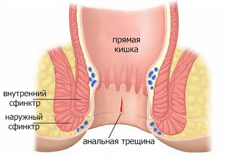 Острый и хронический геморрой, хроническая анальная трещина