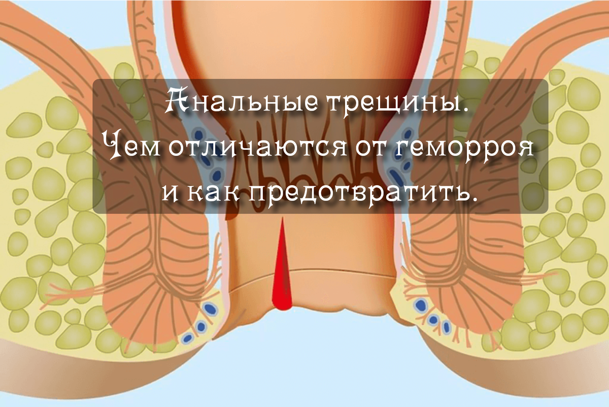 Анальная трещина