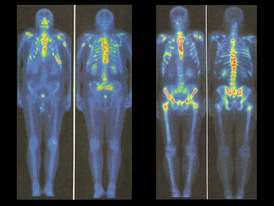 Исследование на облучение. Радионуклидная остеосцинтиграфия. Сцинтиграфия остеомиелит. Радиоизотопное сканирование остеомиелит. Гамма сцинтиграфия скелета.
