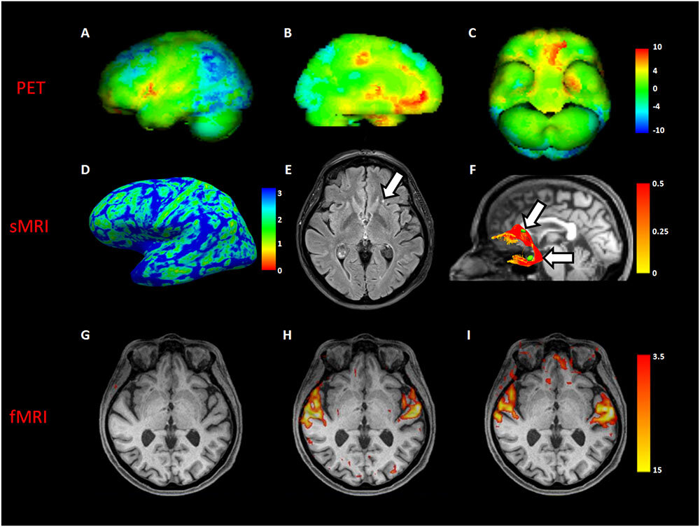 функциональное мрт головного мозга. функциональная мрт мозга. фмрт. фмрт. мрт картирование головного мозга.