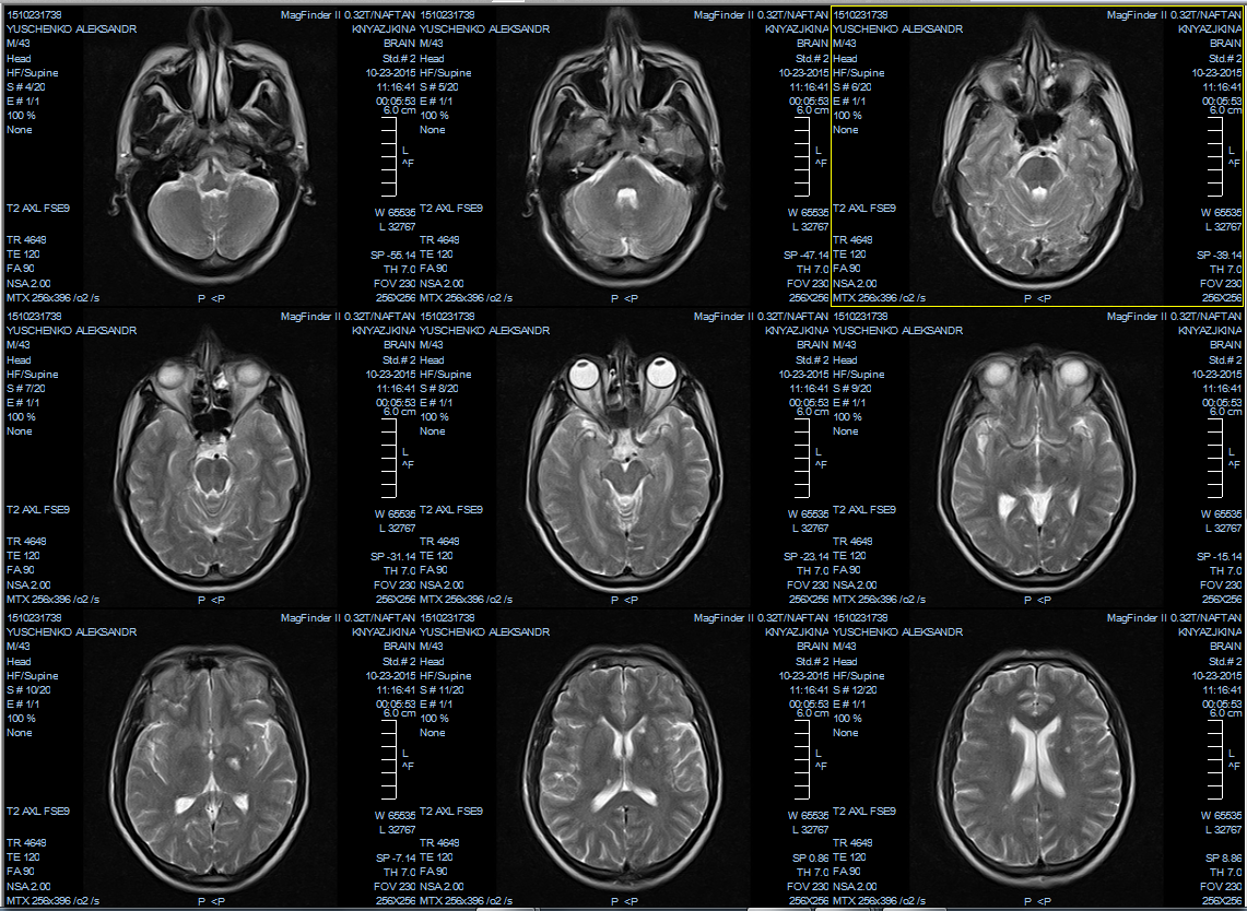 Мрт результаты сразу. Расшифровка снимков мрт головы. Мрт головы расшифровка снимка. Мрт снимки мозга норма. Кт головного мозга расшифровка снимков.