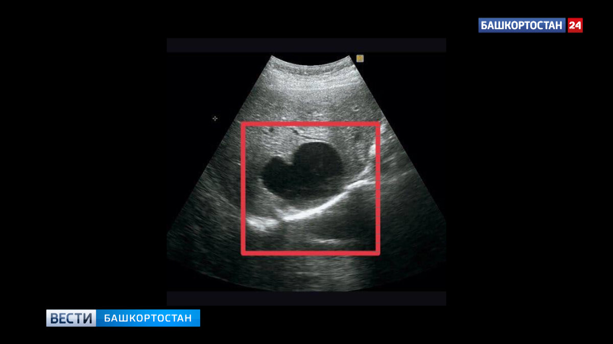    В Башкирии врачи вырезали из печени женщины пузырь с ленточными червями