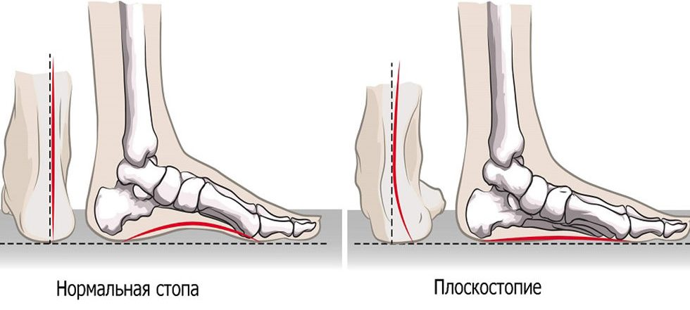 Плоскостопие и варикоз