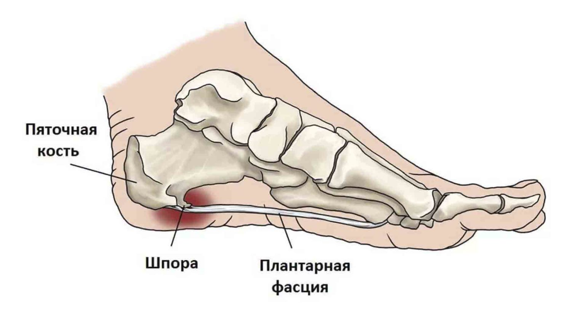 Болит подушечка стопы при ходьбе. Плантарный фасциит стопы. Ахиллова пяточная шпора. Плантарный фасциит рентген.