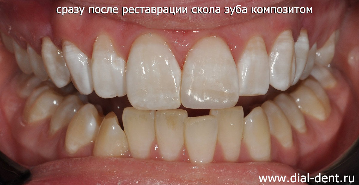 скол зуба отреставрирован композитом.