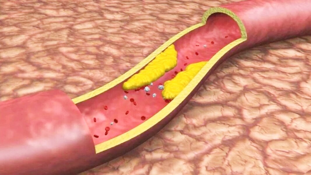 Вот так выглядит холестериновая бляшка в сосуде