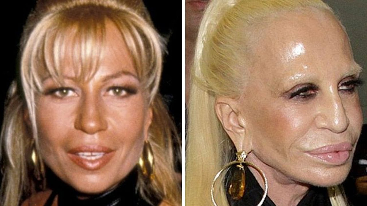 Сидеть после пластики. Donatella Versace до пластики. Донателла Версаче неудачная пластика. Донателла Версаче ботекс. Донателло Версаче без грима.