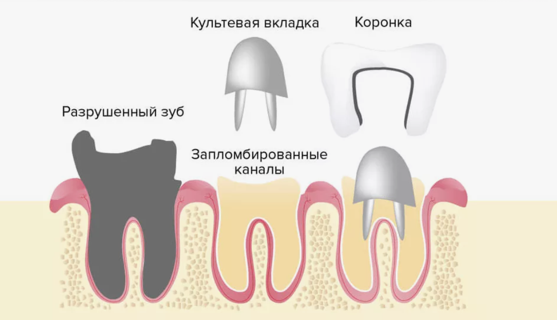 Лечение каналов зуба