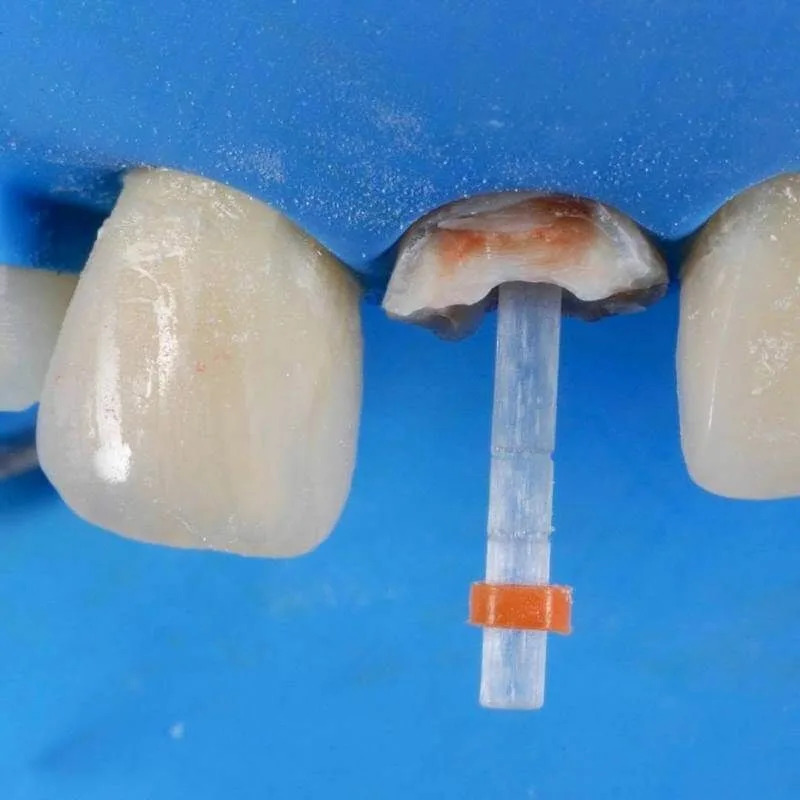 Штифт, установленный в канал зуба