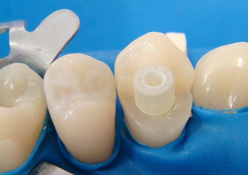 🔎 Коротко Лечение проводят за три-четыре визита. Сначала пролечивают корневые каналы зуба и устанавливают в них штифты.