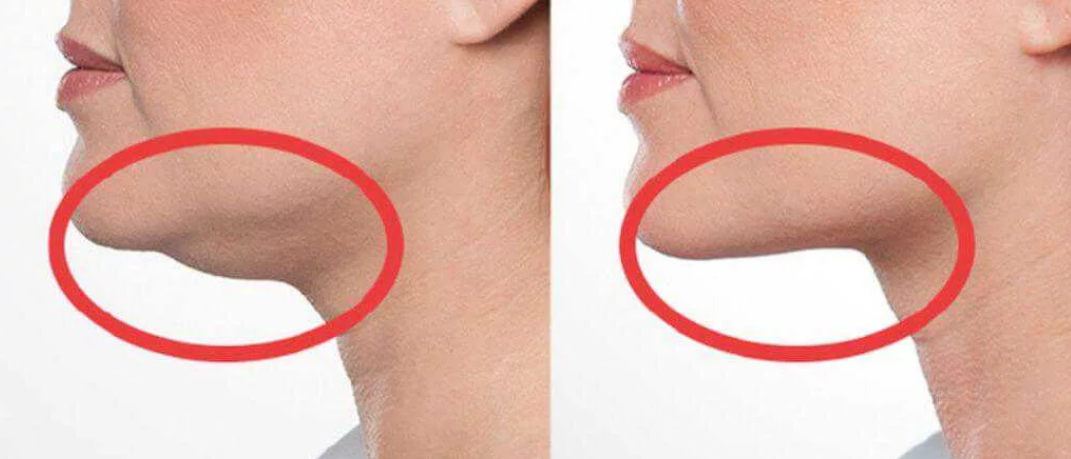 Второй подбородок у женщин. Липосакция шеи и подбородка. Липолитики для второго подбородка. Двойной подбородок. Липосакция подбородка.