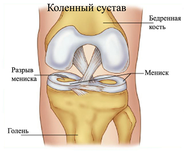 Повреждение мениска коленного сустава