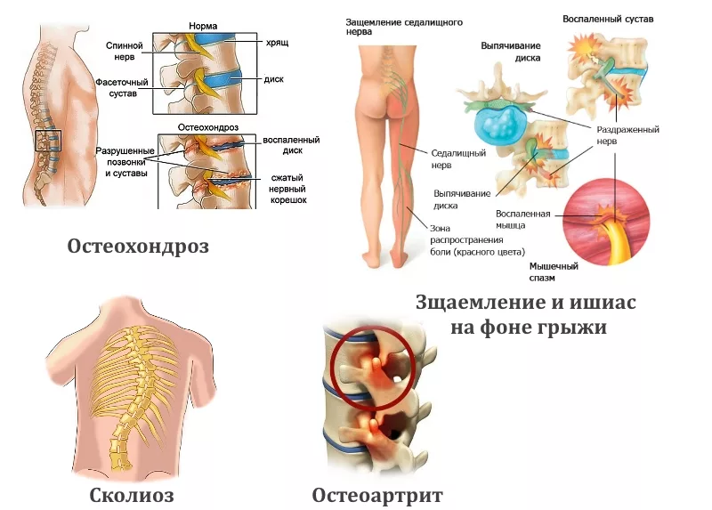 Боль в пояснице, отдаёт в ягодицу или бедро