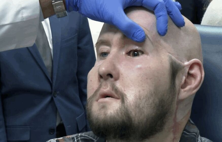    Американские хирурги провели первую в мире полную трансплантацию глаза человека