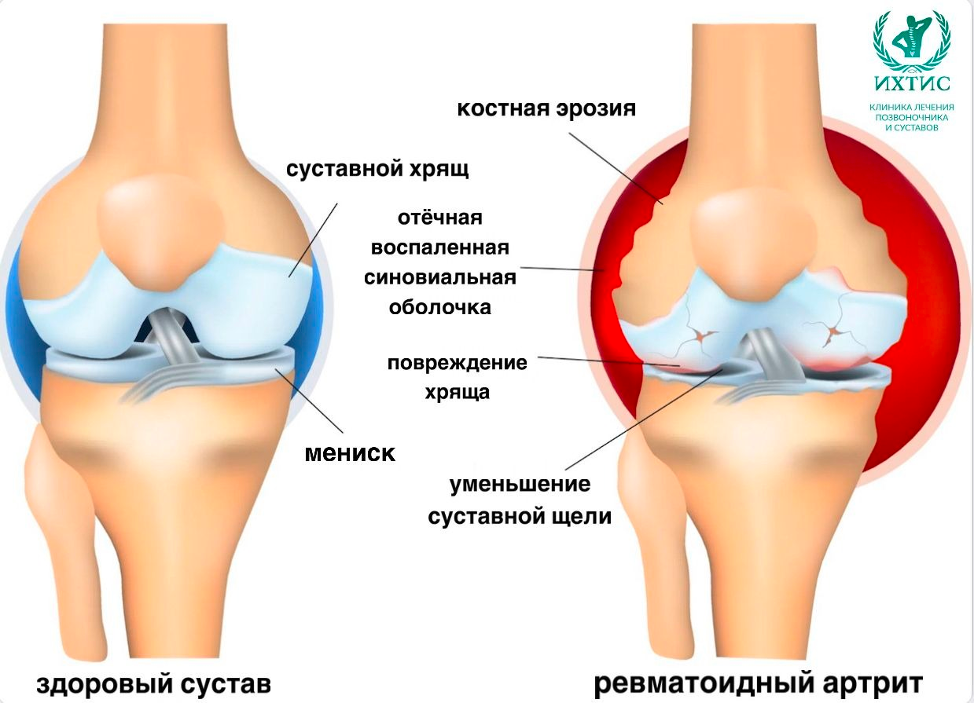  Что такое ревматоидный артрит? Ревматоидный артрит (РА) — это тип аутоиммунного заболевания, которое вызывает воспаление в суставах и окружающих тканях.