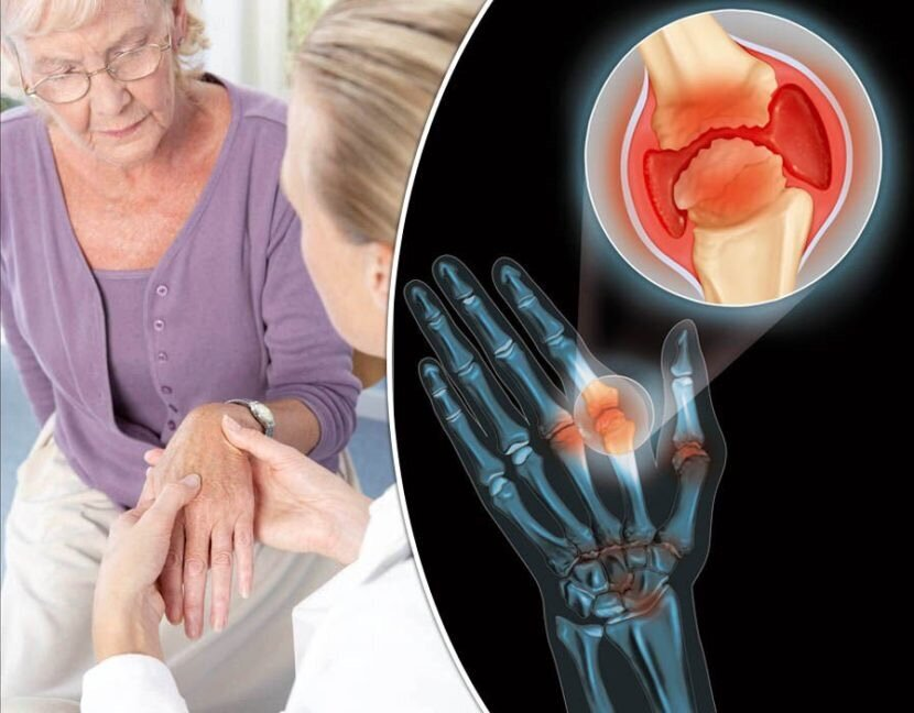  Что такое ревматоидный артрит? Ревматоидный артрит (РА) — это тип аутоиммунного заболевания, которое вызывает воспаление в суставах и окружающих тканях.-2