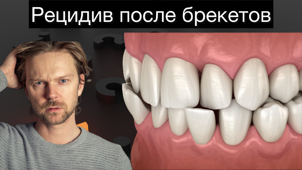 Брекеты рецидив