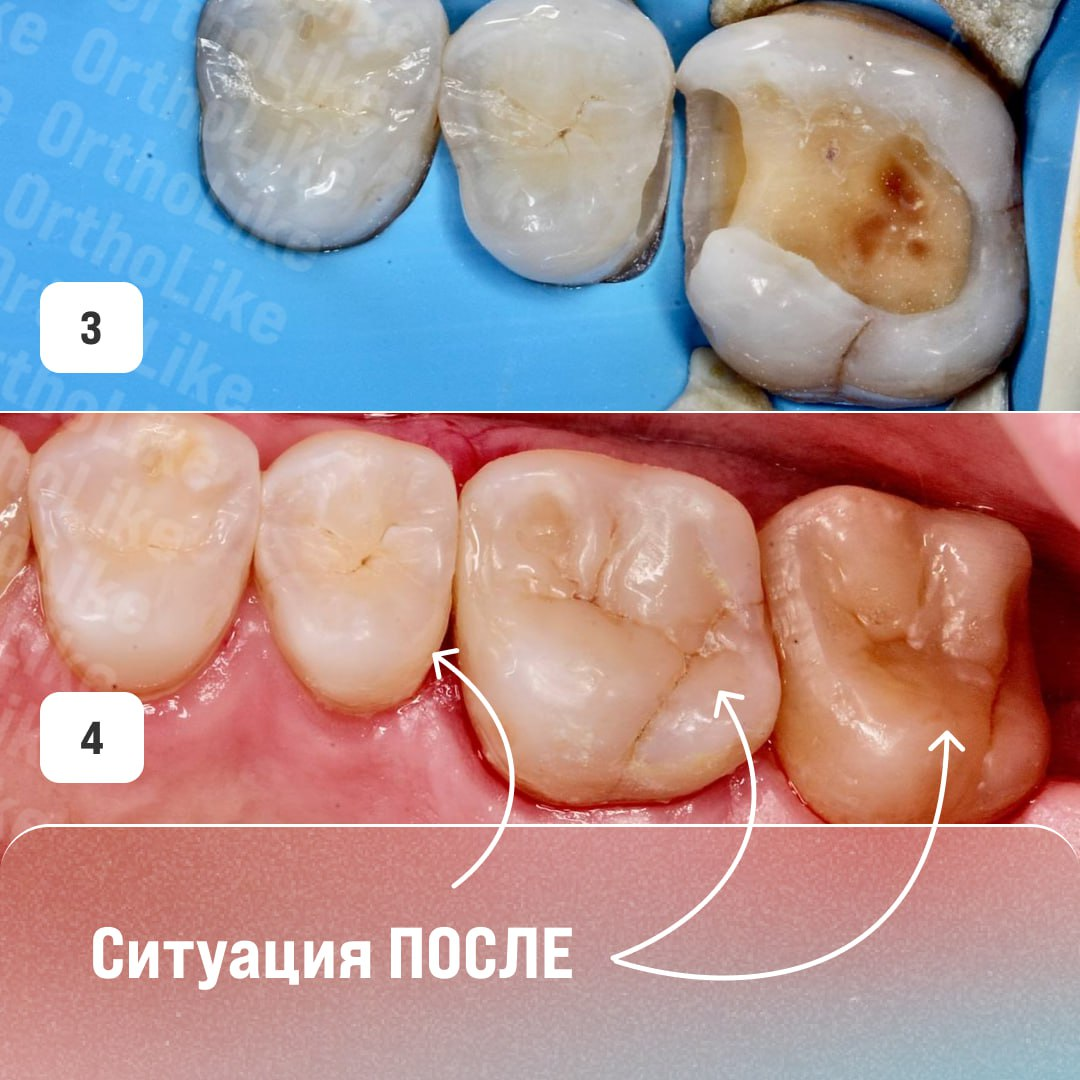 Реставрация жевательных зубов в OrthoLike: кейс стоматолога-терапевта  Светланы Колосковой | Андрей Жук эксперт по ортодонтии | Дзен