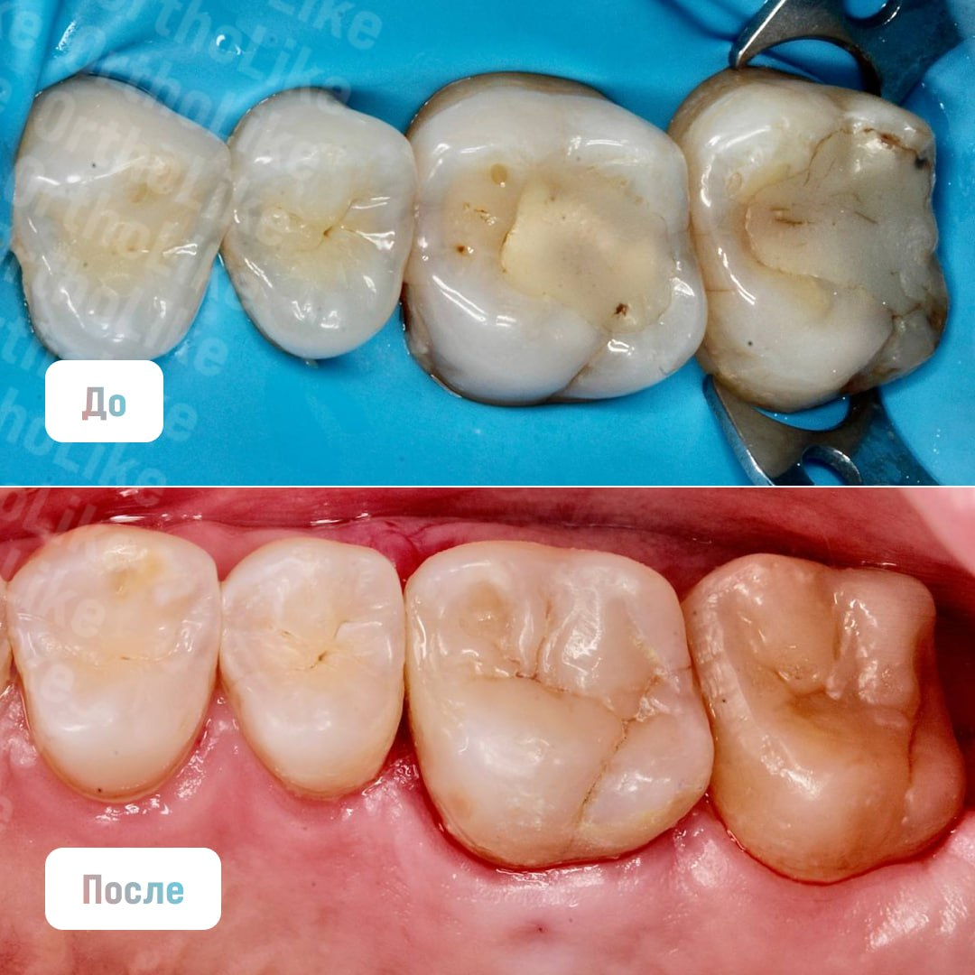 Реставрация жевательных зубов в OrthoLike: кейс стоматолога-терапевта  Светланы Колосковой | Андрей Жук эксперт по ортодонтии | Дзен