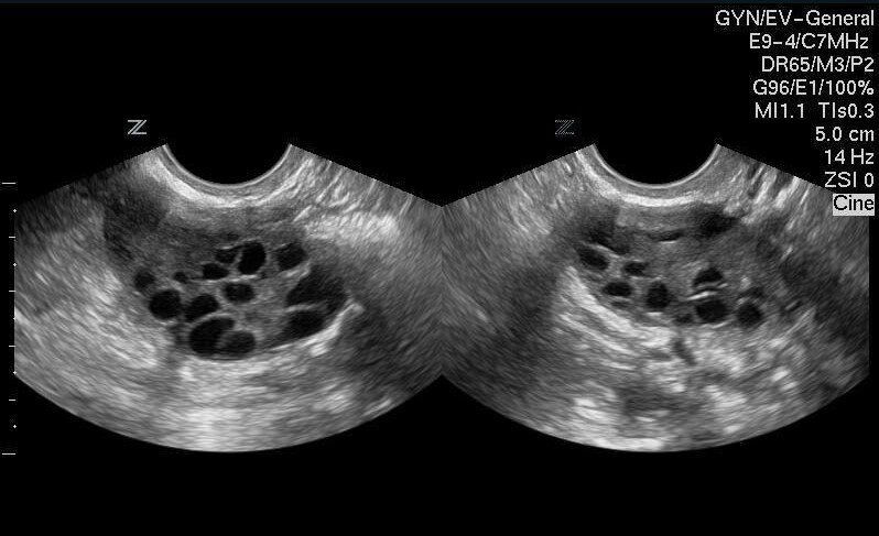 Склерокистоз яичников. УЗИ мультифолликулярных яичников. Синдром поликистозных яичников УЗИ. Синдром поликистоза яичников на УЗИ. Мультифолликулярный яичник на УЗИ.