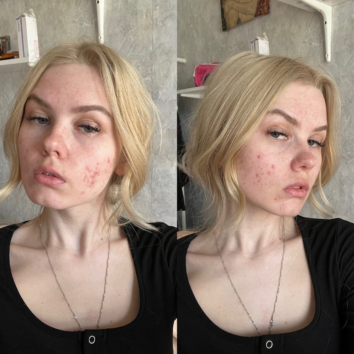 апрель 2022, первый день приема изотретиноина