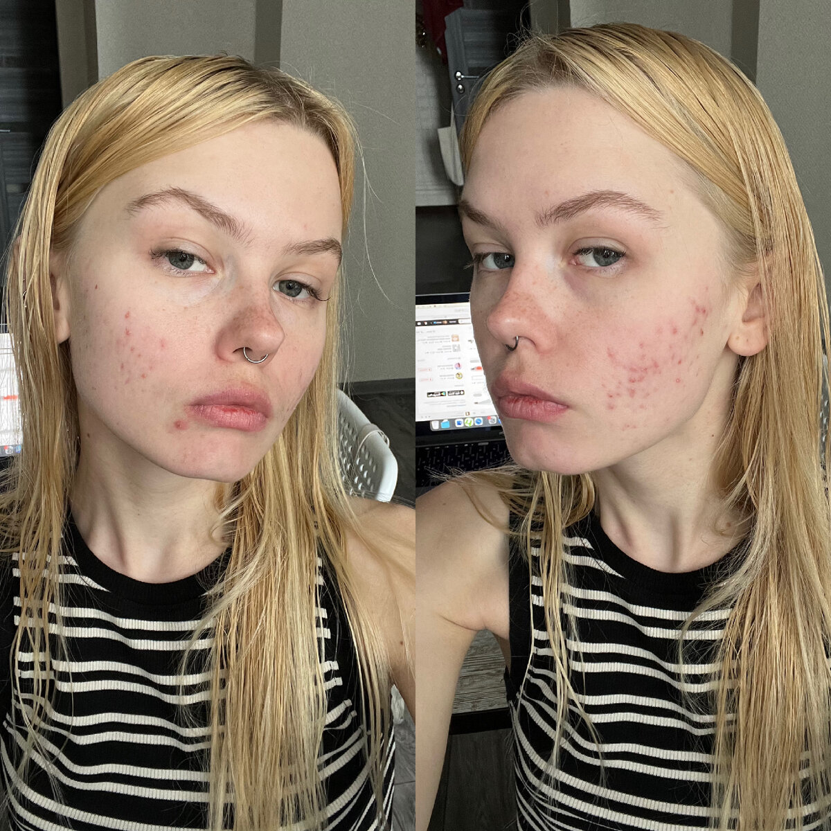 7 неделя приема ретиноидов, июнь 2022