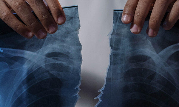Рак лёгкого – есть способ получше | ONCOLOGY.ru | ОНКОЛОГИЯ.ру | Дзен