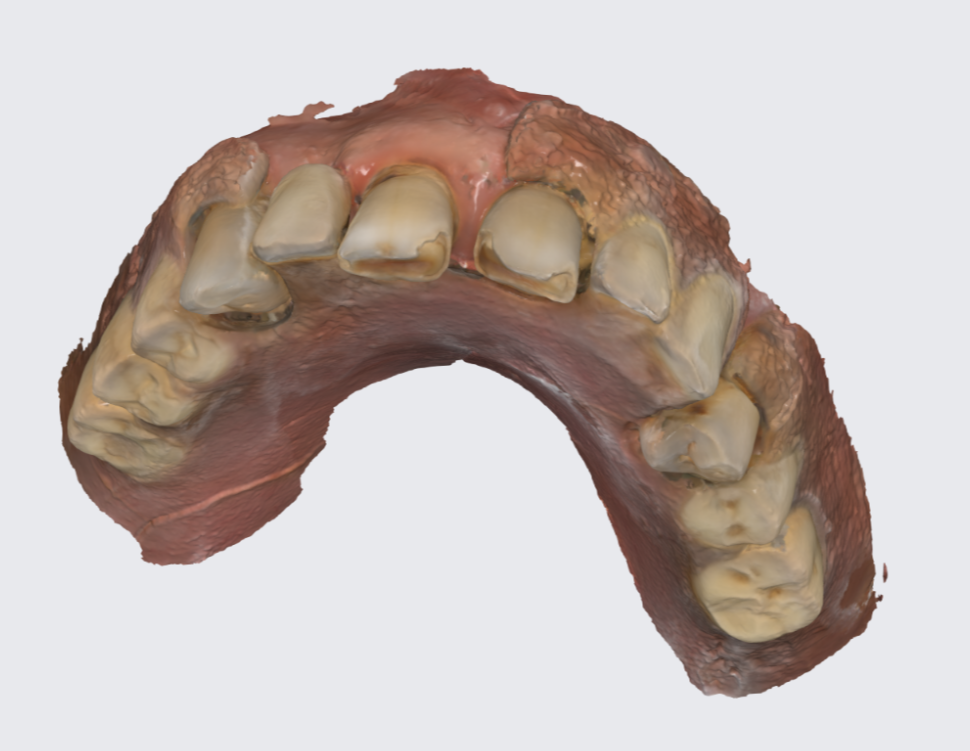 Верхняя челюсть, цифровой слепок.