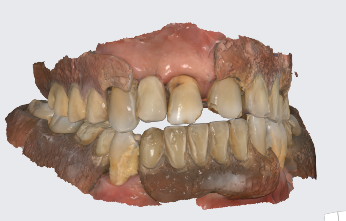 Съёмные протезы,. цифровой слепок.