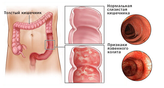 Колит: виды, диагностика и методы лечения заболевания ᐉ Сеть аптек 