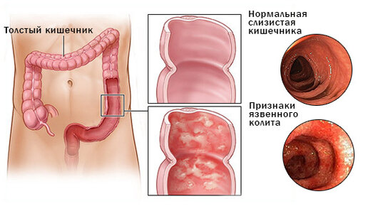 Хронический колит - диагностика