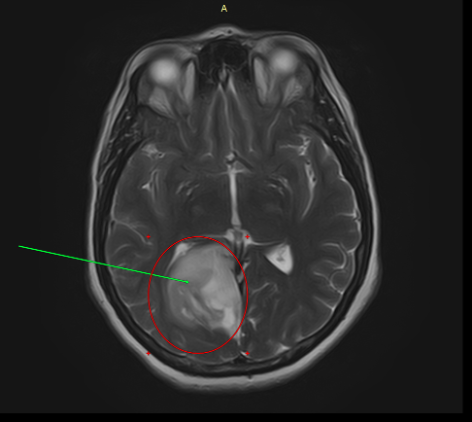 МРТ головного мозга: опухоль правой затылочной доли головного мозга.