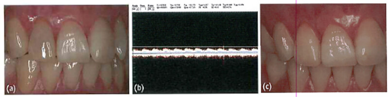 Рисунок 1. (a) В случае 1 изменение цвета зуба № 12 наблюдалось через 2 недели после травмы; (b) результат ультразвукового допплеровского исследования через 6 недель после травмы. Наблюдается типичное пульсирующее изображение, что представляет собой нормальную жизнеспособную пульпу; (c) Через 10 недель после травмы зуб приобрел нормальный оттенок.