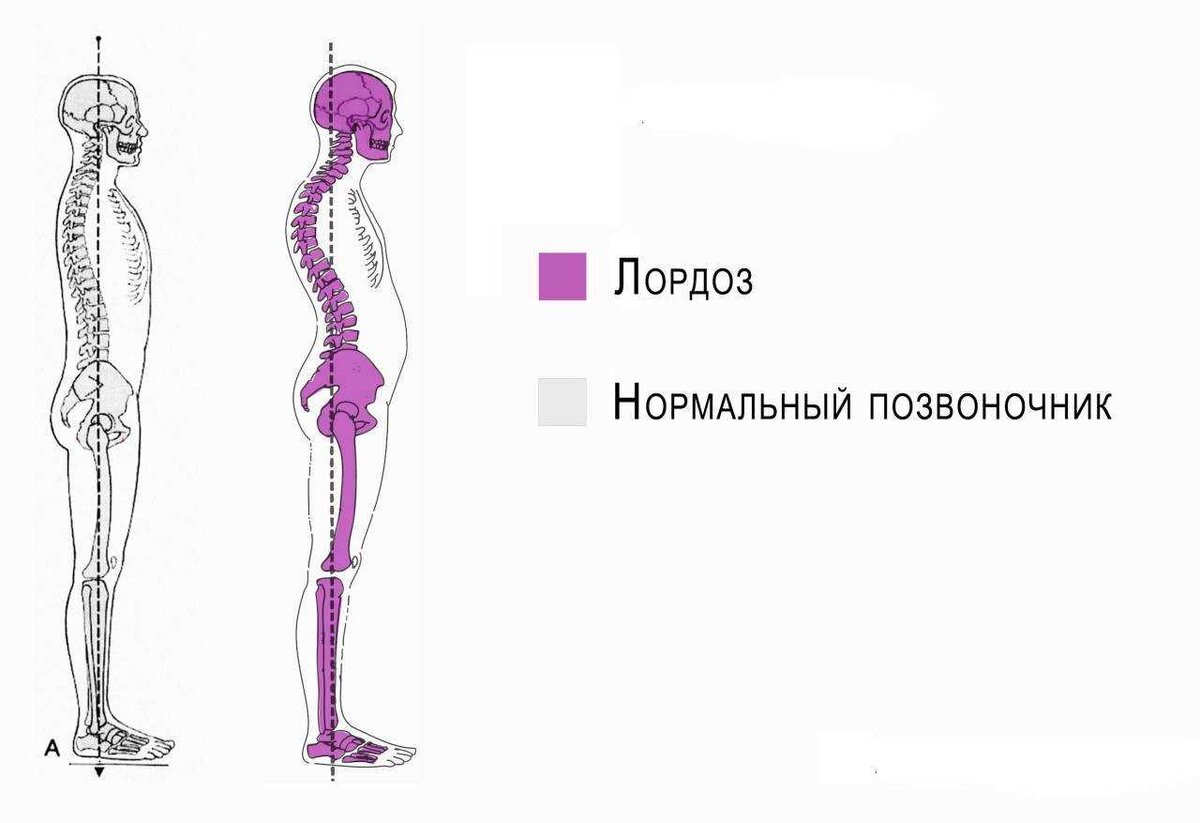 Сильно выпирает животик? Скорее всего это не жир, это - гиперлордоз. |  Доктор Подручкин | Дзен