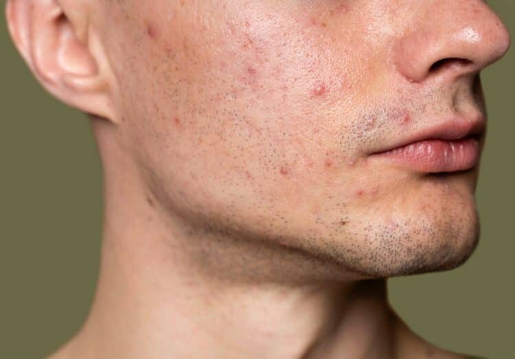 Креатиновые прыщи