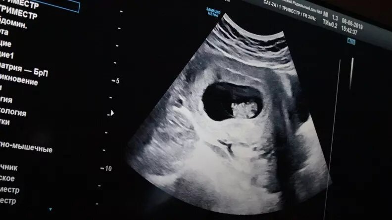     На сегодняшний день уже, как минимум, в 2 регионах России частные клиники отказались от проведения абортов. Может ли Тюменская область вступить в их ряды и чем это обернется для тюменских женщин? «Наш город» разобрался в вопросе.