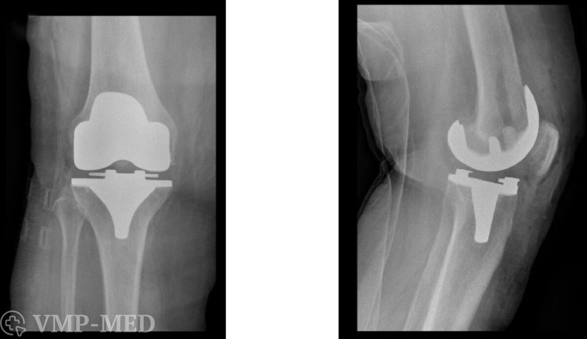 Эндопротезирование коленного сустава | ВМП-Медицина | Дзен
