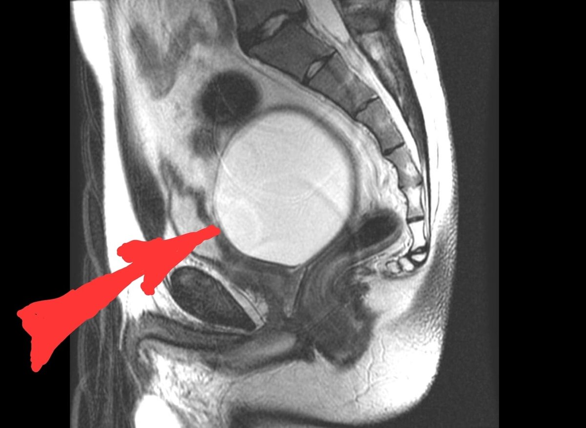Та самая киста в области малого таза.