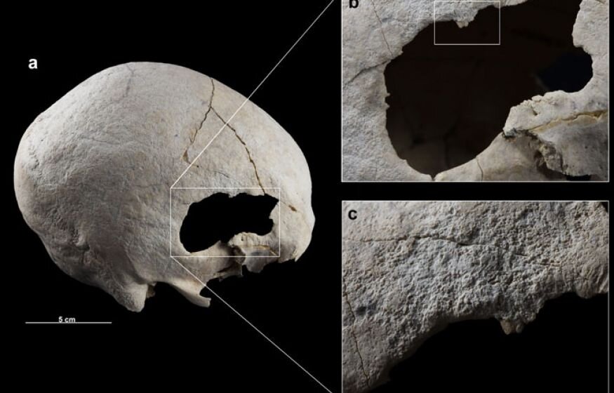    В Испании найдены доказательства 4500-летней операции на черепе