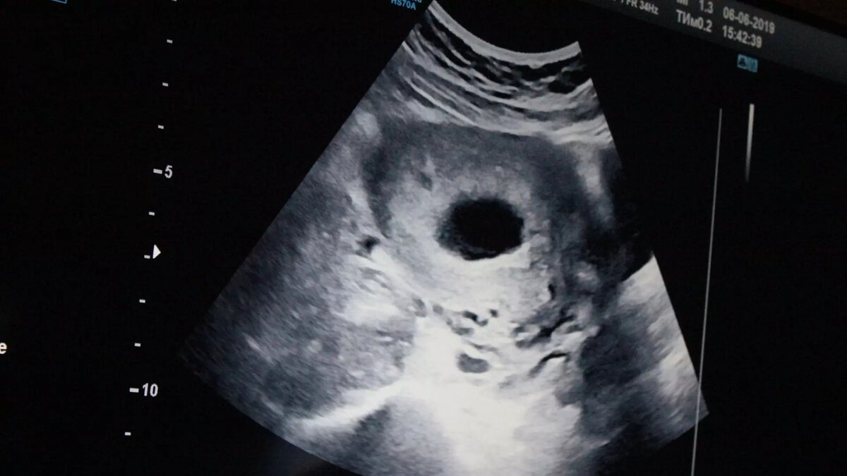     Госдума начала работу над законопроектом о запрете абортов в частных клиниках.