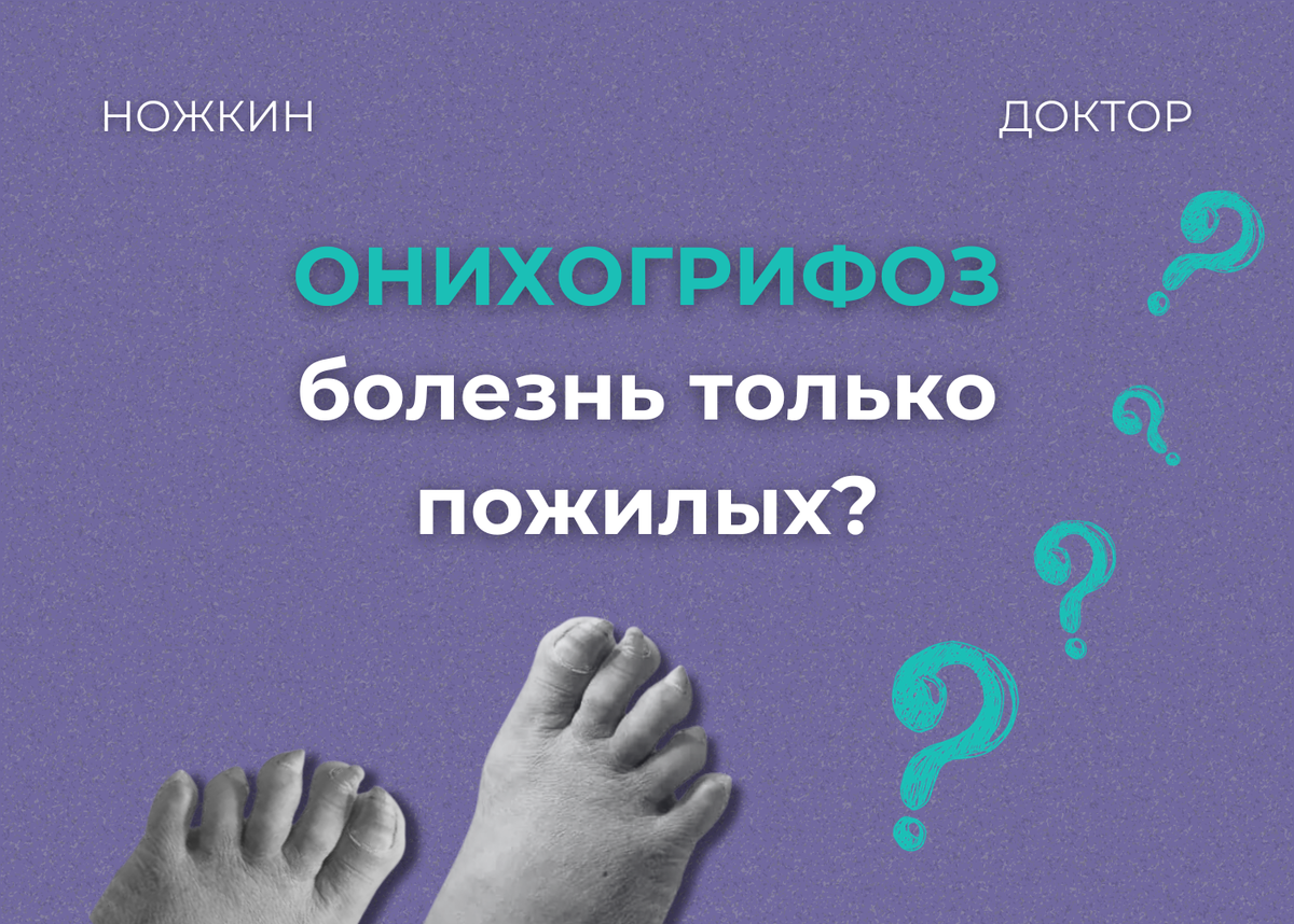 Онихогрифоз – из-за тесной обуви? Причины утолщения ногтей и срочного  визита к подологу | Ножкин Доктор/ Подолог в Москве | Дзен