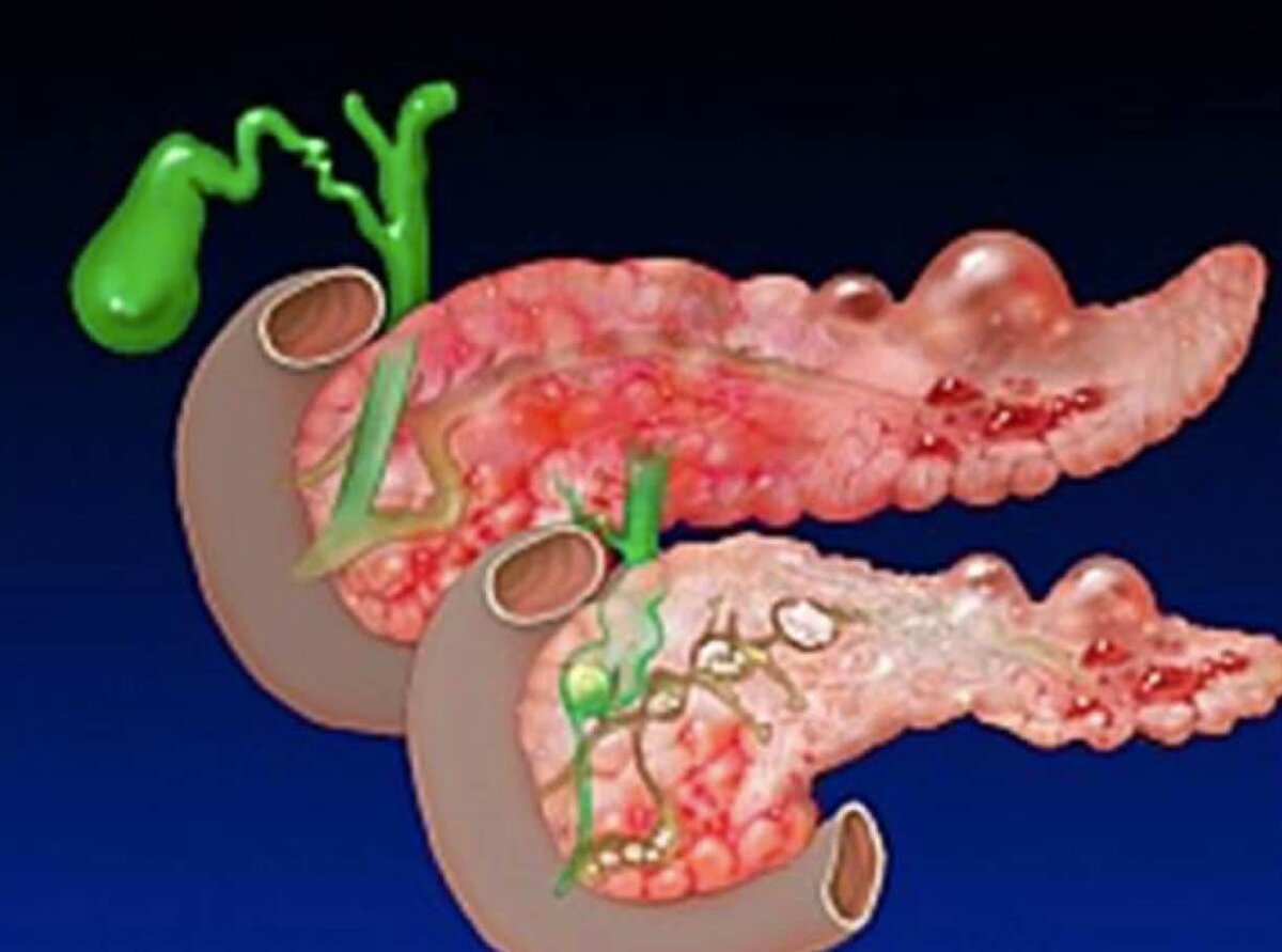 Острый панкреатит рисунки