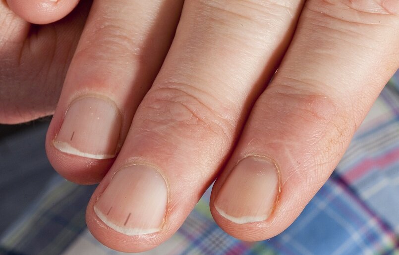 В практике nail-мастеров нередки случаи, когда после снятия покрытия на ногтях клиента обнаруживаются темные точки и полосы, напоминающие занозы.