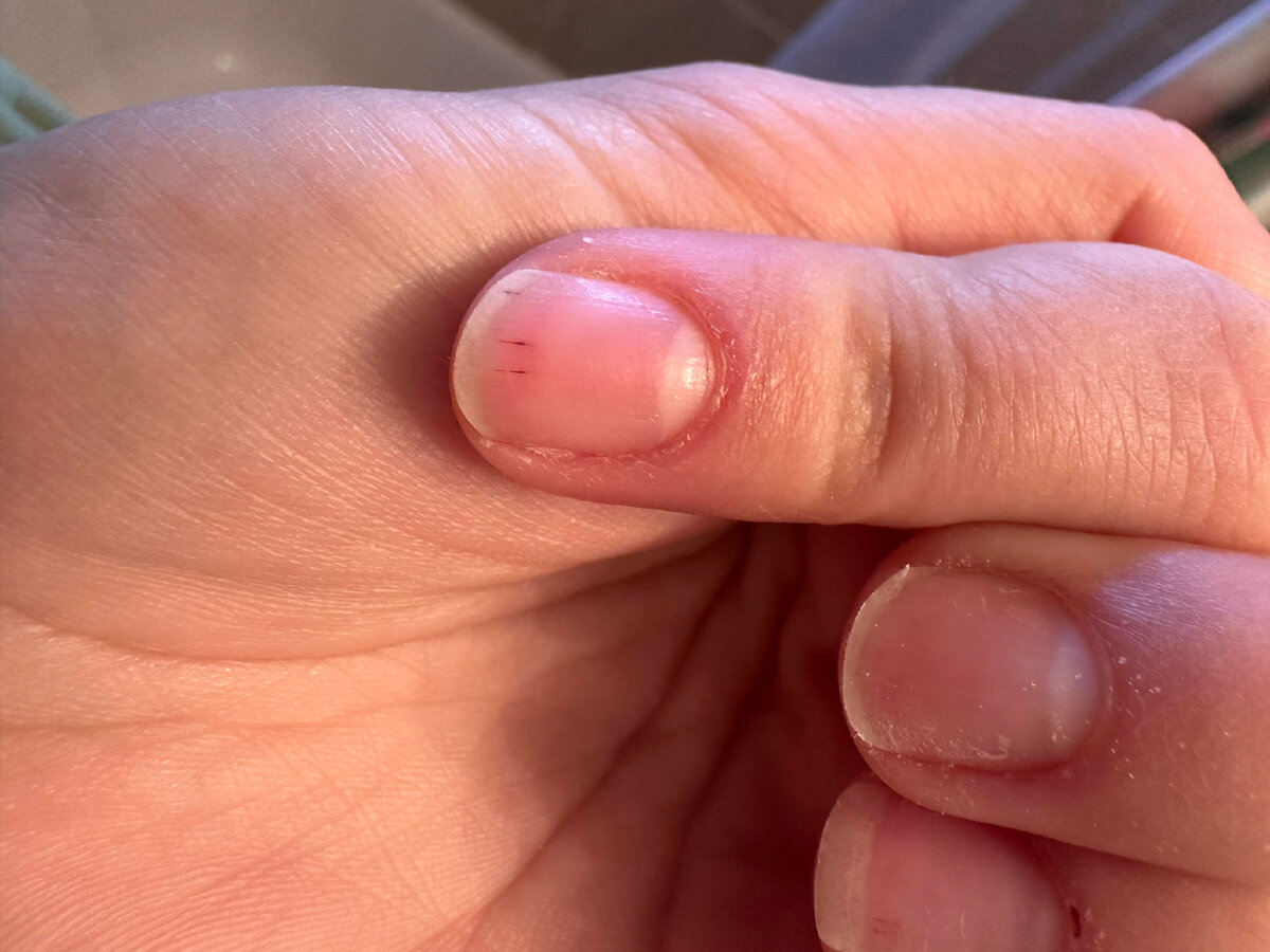 В практике nail-мастеров нередки случаи, когда после снятия покрытия на ногтях клиента обнаруживаются темные точки и полосы, напоминающие занозы.-2