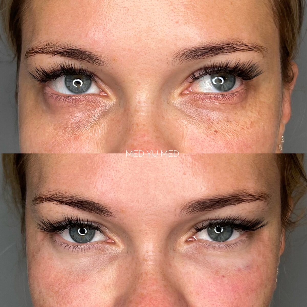 Коррекция носослезной борозды. Врач: Арюна