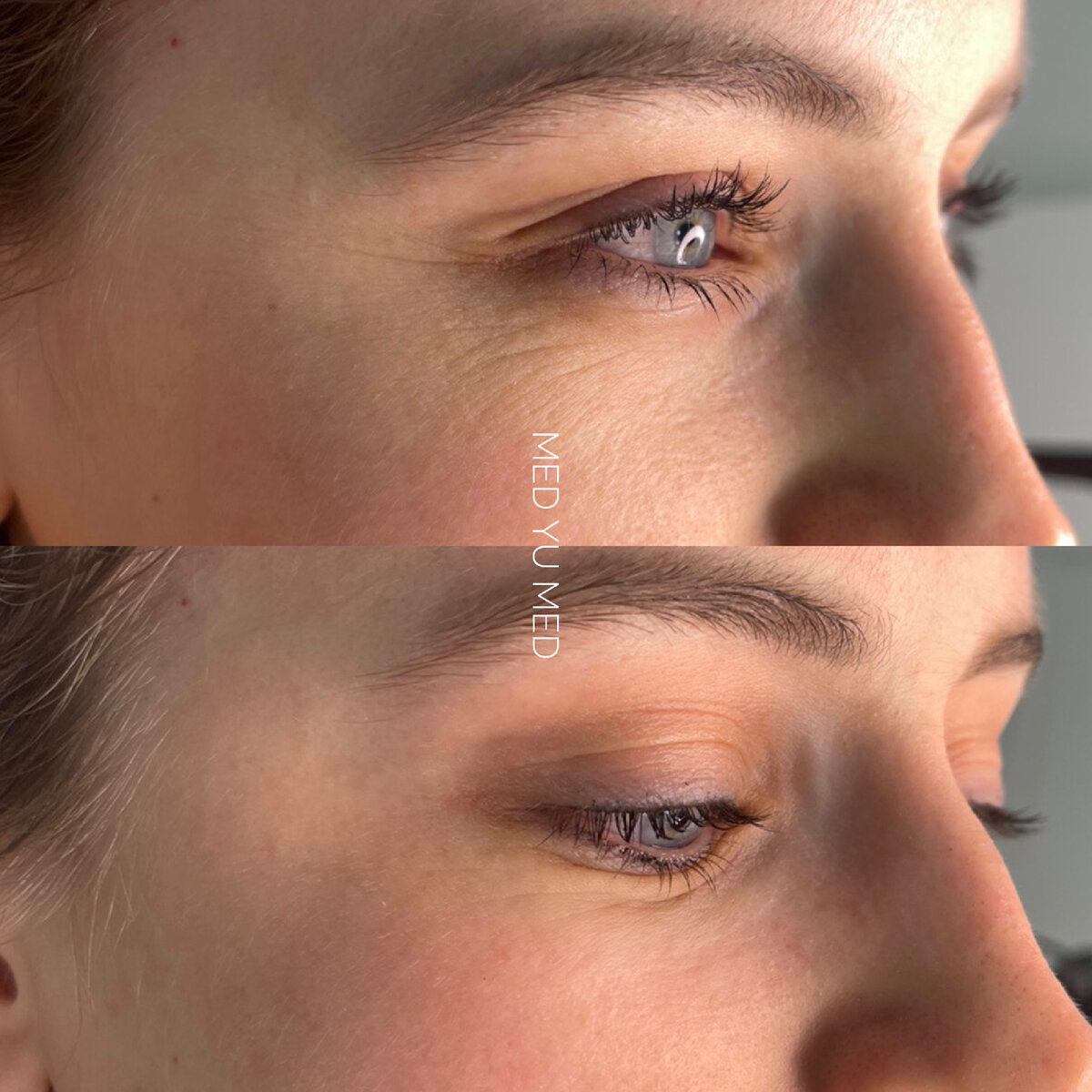 Биоревитализация зоны вокруг глаз. Врач: Екатерина