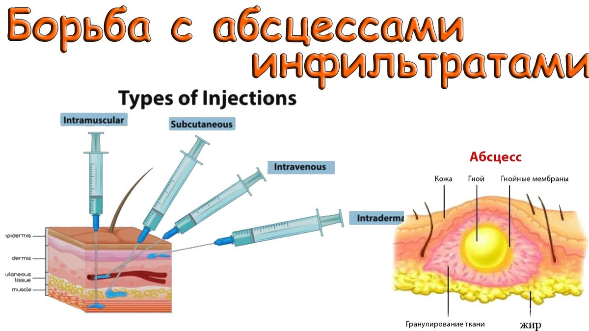 Чтоб уколы рассосались. Постинъекционный абсцесс. Постинъекционный инфильтрат