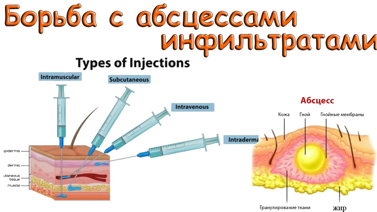 Постинъекционный абсцесс. Постинъекционный инфильтрат.