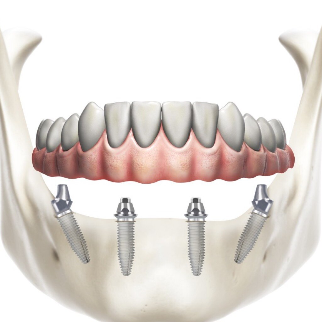 Зубы на 4х имплантах. All on 4 имплантация Нобель. Имплантация челюсти на 4 имплантах.