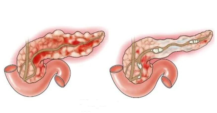 Воспаление поджелудочной железы. Острый и хронический панкреатит. Хронический отечный панкреатит. Острый и подострый панкреатит это-. Острый панкреатит хронический панкреатит.